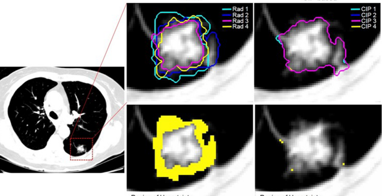 Application of the 3D Slicer Chest